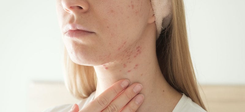 Cystic acne treatment